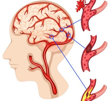 Blood Clot in Brain Treatment Nawanshahr